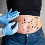 Abdominoplasty Surgery