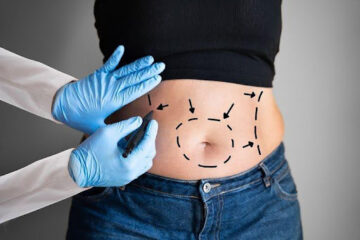 Abdominoplasty Surgery